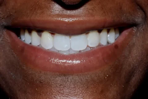 Invisalign with front teeth bonding after