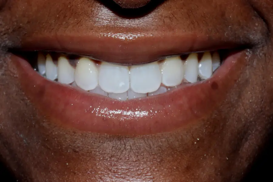 Invisalign with front teeth bonding after