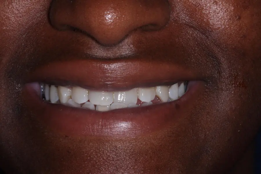 Invisalign with front teeth bonding Before