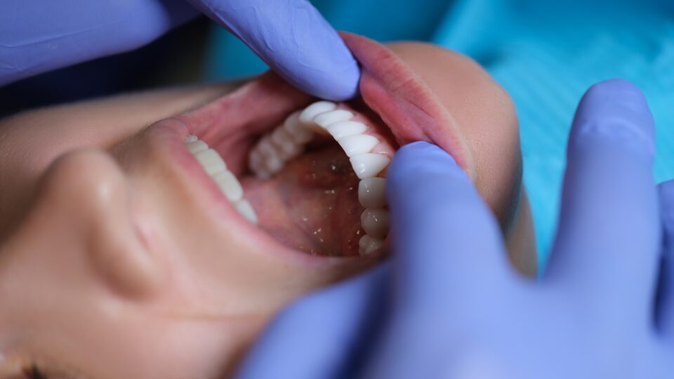 Composite Dental Veneers