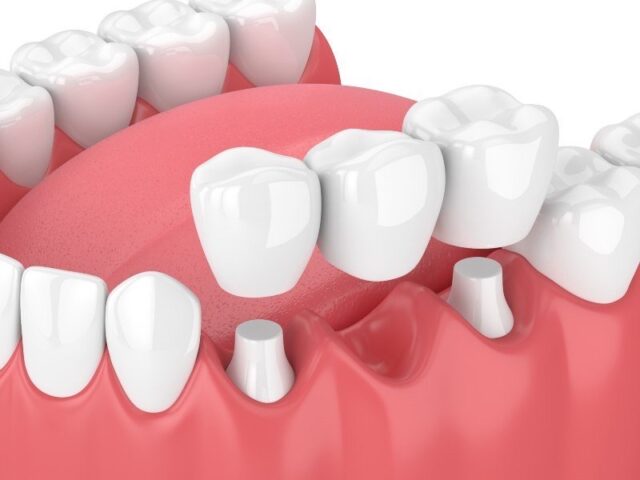 Dental Crowns Pompano Beach FL