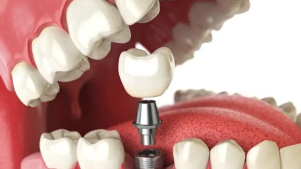 Dental Implants Your Path to a Restored Smile and Confidence