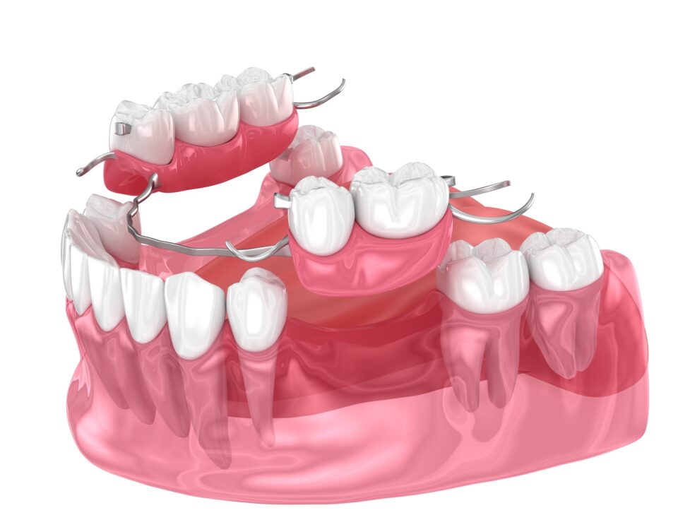 Dental Bridges Pompano Beach FL