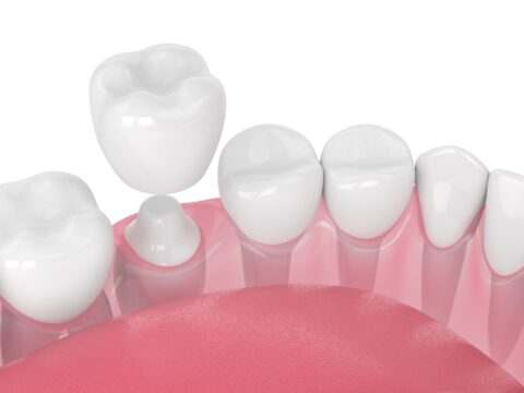 Dental Crowns: Take The Steps Towards A Confident And Beautiful Smile