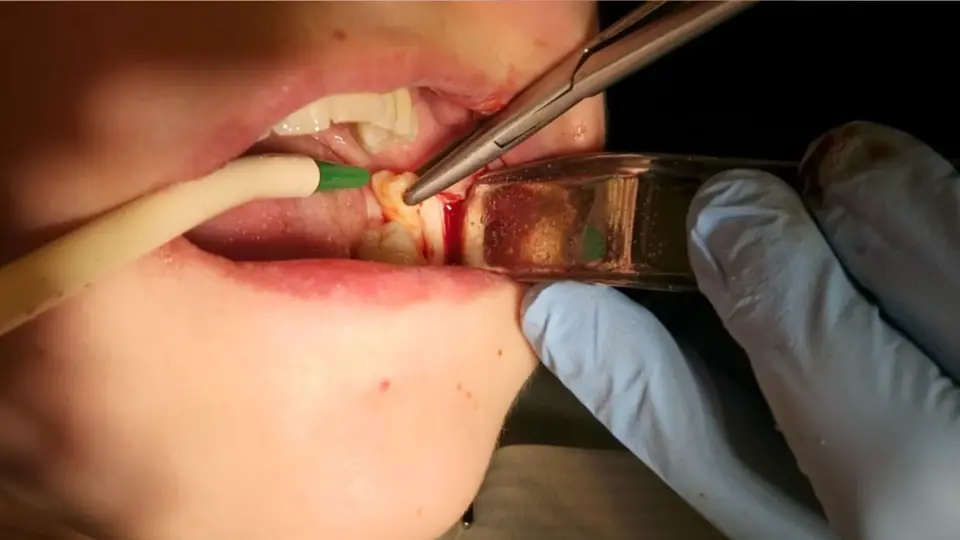 Extractions Made Easy Tooth Removal Procedures