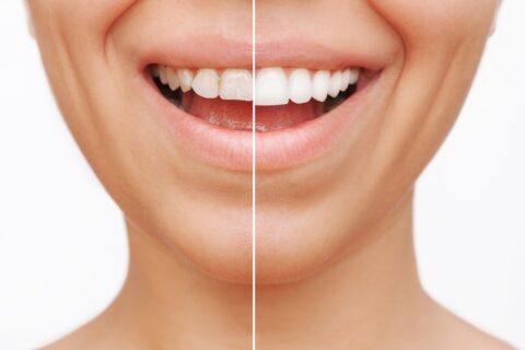 Full Mouth Reconstruction Dentist in Pompano FL