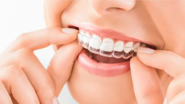 How Long Does a Dental Appointment Typically Last for Invisalign Treatment pompano beach FL