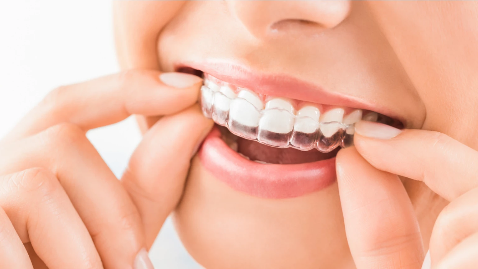 How Long Does a Dental Appointment Typically Last for Invisalign Treatment