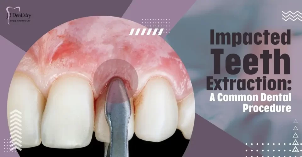 Impacted Teeth Extraction: A Common Dental Procedure