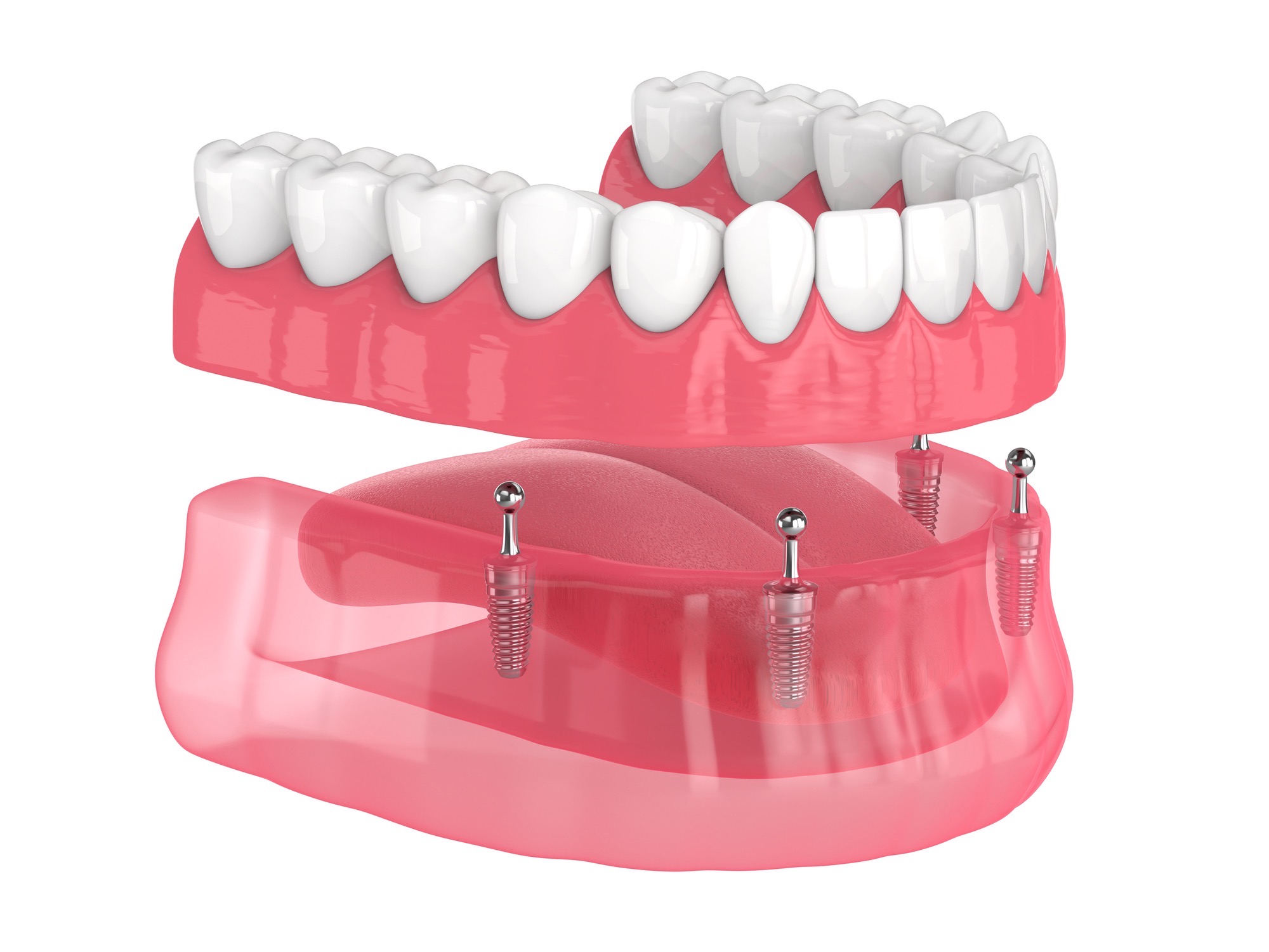 Implant Supported Dentures