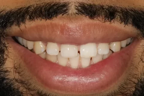 Invisalign with front teeth bonding after