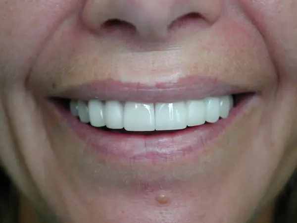 Laura U - After - Full Mouth Reconstruction with crowns and 1 implant 600