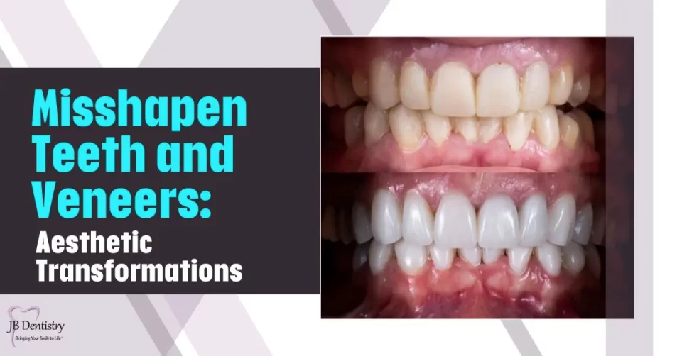 Misshapen Teeth and Veneers: Aesthetic Transformations