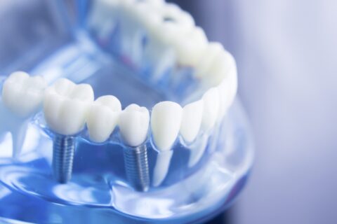 Multi-Tooth Dental Implant