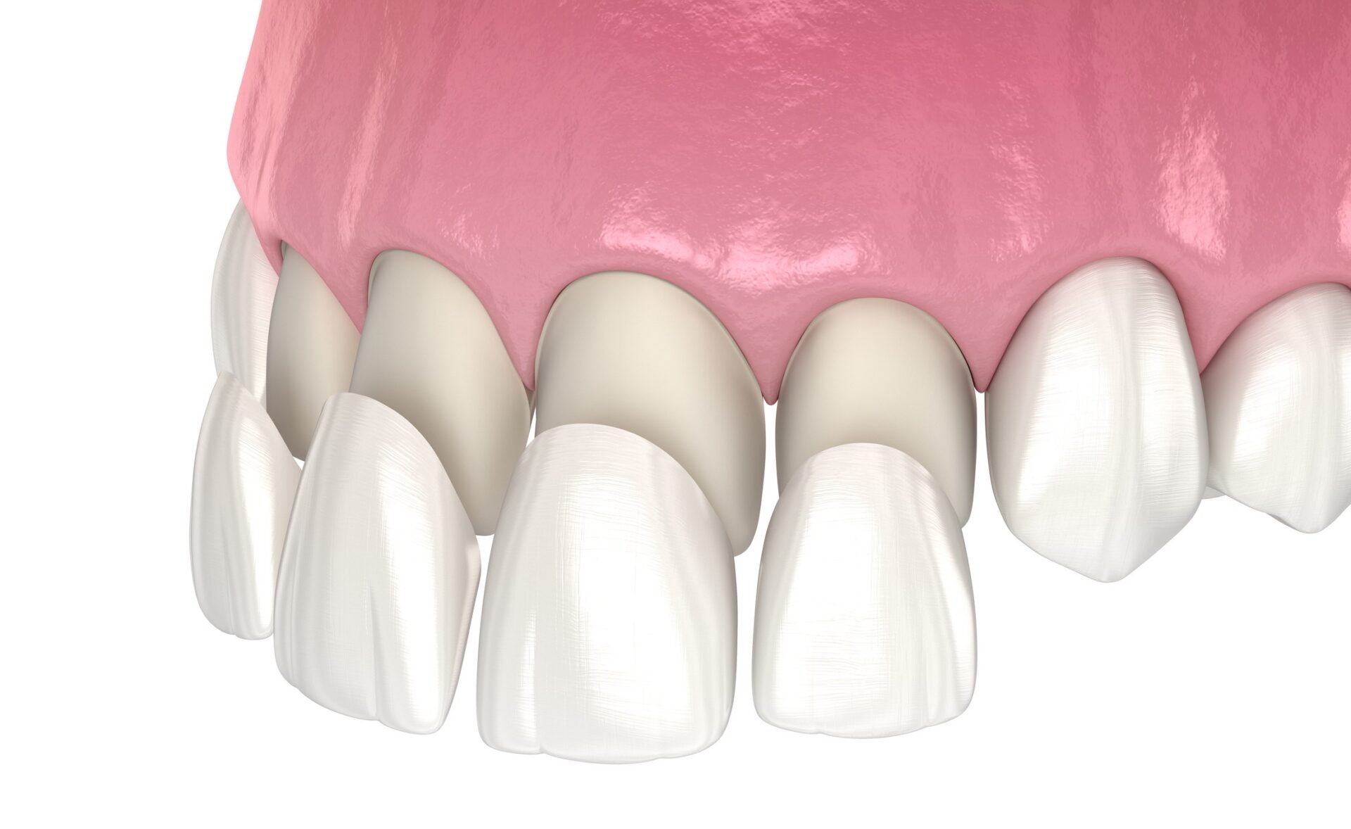 Porcelain Dental Veneers in Pompano