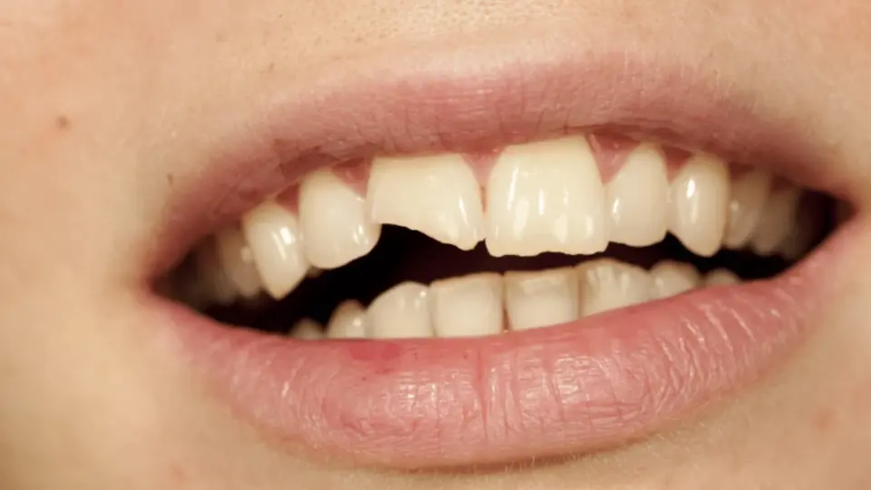 Restoring Your Smile Options for a Broken Tooth
