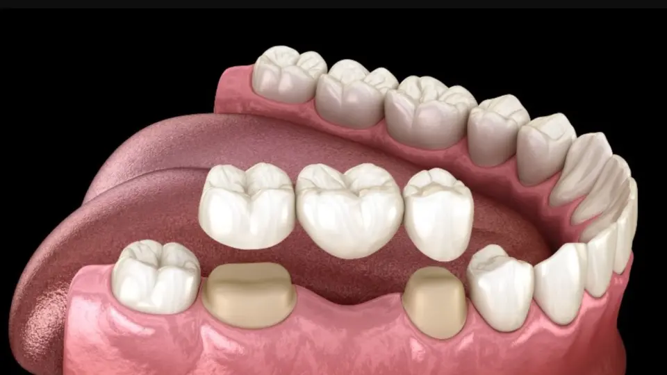 Same-Day Dental Crowns The Convenience and Benefits Explained