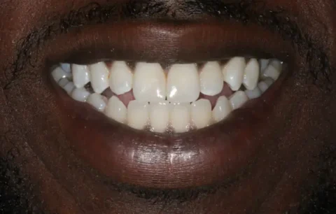 Invisalign with front teeth bonding after