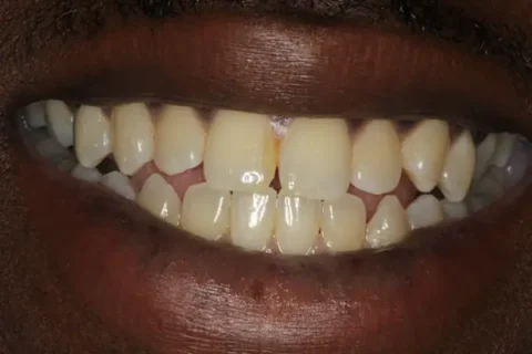 Invisalign with front teeth bonding Before