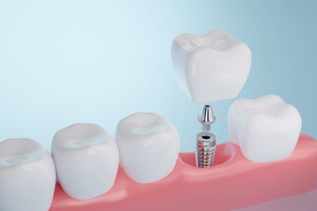 Single Tooth Dental Implant
