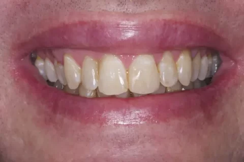 Invisalign with front teeth bonding after