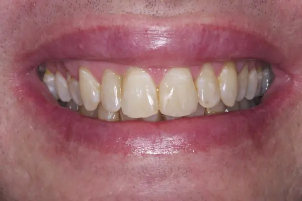 Steve-K -close-up - After - 4 -  upper Teeth composite bonding