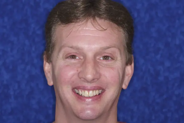 Steve-K- After 4-upper-front-teeth - Single Tooth Bonding