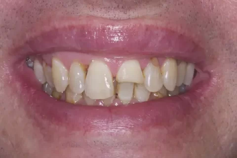 Invisalign with front teeth bonding Before