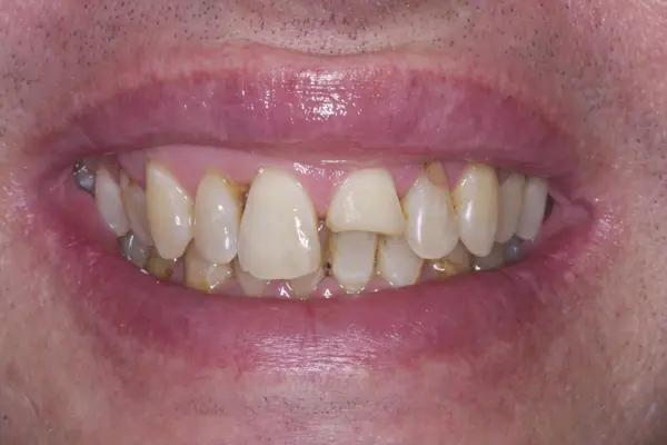Steve-K- close-up - Before 4-upper-front-teeth - Single Tooth Bonding