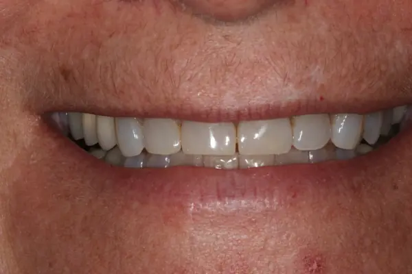 t-front-teeth-close-up- After - Accident Repair With Front Teeth Bonding