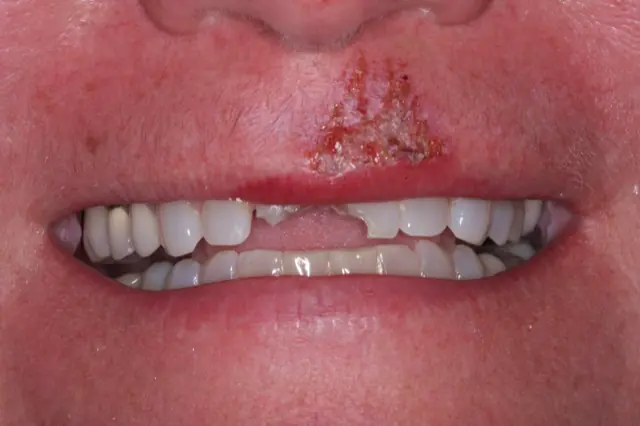 t-front-teeth-close-up- Before - Accident Repair With Front Teeth Bonding