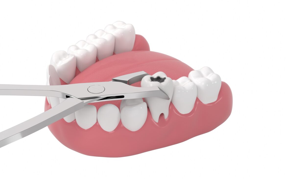 Tooth extractions post op instructions jb dentistry