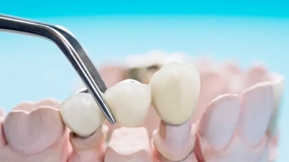 Understanding Dental Crowns What You Need to Know for Strong Teeth