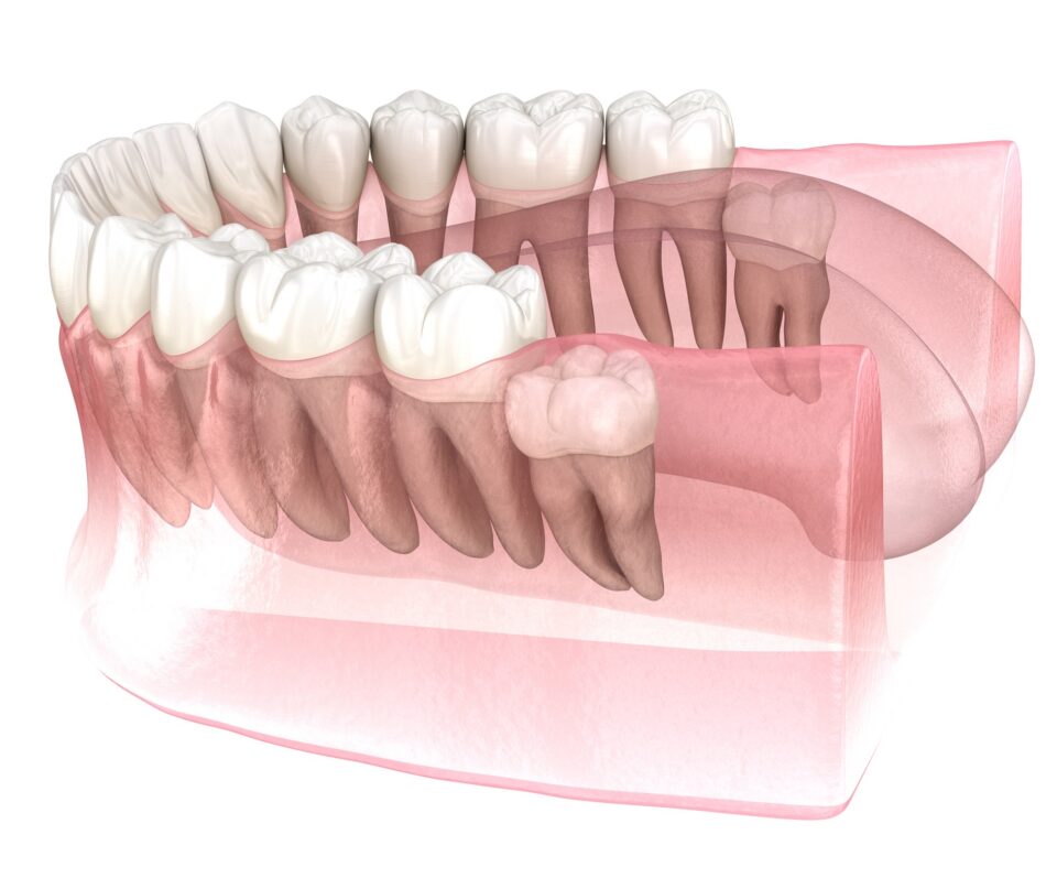 Wisdom Tooth Extraction Pompano Beach FL