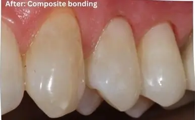 Invisalign with front teeth bonding after