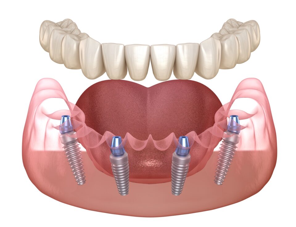 All on 4 Dental Implants