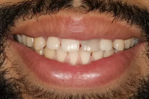 Invisalign with front teeth bonding Before