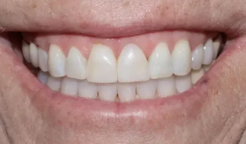 Invisalign with front teeth bonding after