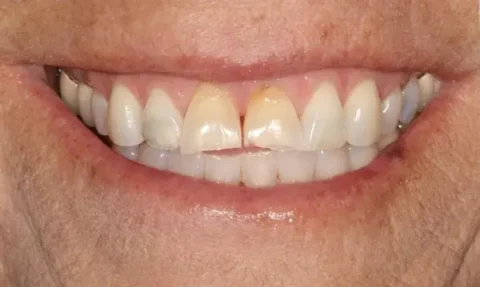 Invisalign with front teeth bonding Before