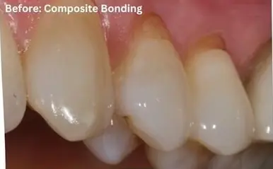 Invisalign with front teeth bonding Before