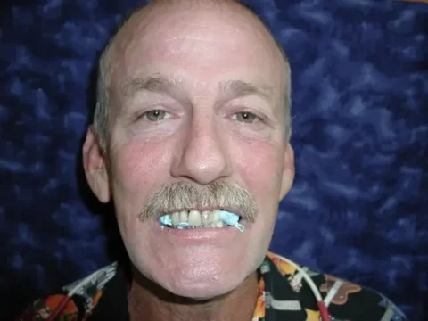 Invisalign with front teeth bonding Before
