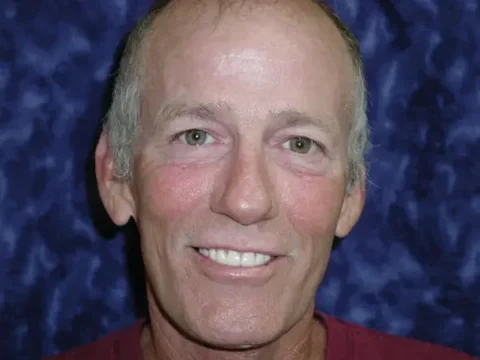 Invisalign with front teeth bonding after