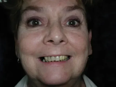 Invisalign with front teeth bonding Before