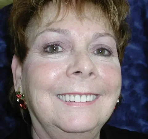 Invisalign with front teeth bonding after