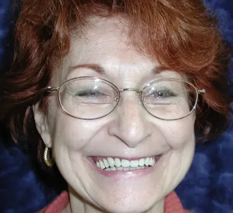 Invisalign with front teeth bonding Before