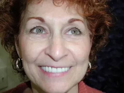 Invisalign with front teeth bonding after