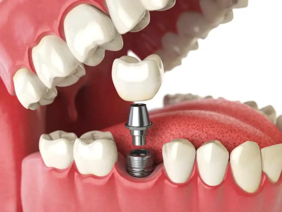Dental Implant - JB Dentistry Process pompano beach FL