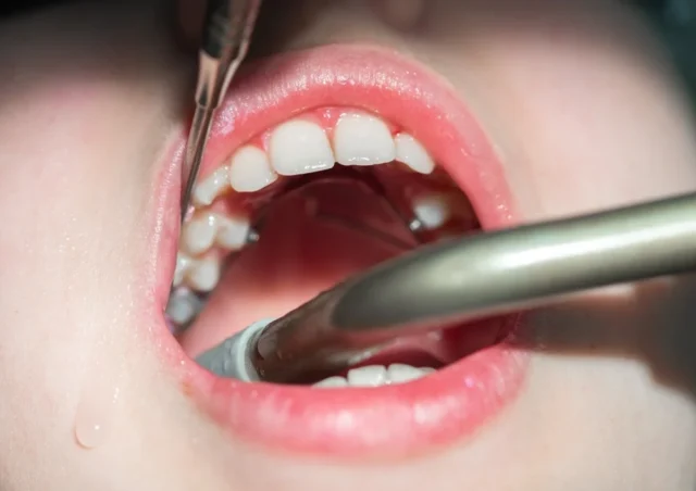 Teeth Cleaning Dentist Pompano Beach FL Near Me